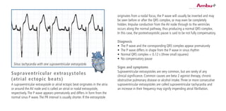 originates from a nodal focus, the P wave will usually be inverted and may
be seen before or after the QRS complex, or may even be completely
hidden. Impulse conduction from the AV node through to the ventricles
occurs along the normal pathway, thus producing a normal QRS complex.
In this case, the postextrasystolic pause is said to be not fully compensatory.
Diagnosis
•	 The P wave and the corresponding QRS complex appear prematurely
•	 The P wave differs in shape from the P wave in sinus rhythm
•	 Normal QRS complex < 0.12 s (three small squares)
•	 No compensatory pause
Signs and symptoms
Supraventricular extrasystoles are very common, but are rarely of any
clinical significance. Common causes are beta 2 agonist therapy, chronic
obstructive pulmonary disease or alcohol intake.Three or more consecutive
supraventricular extrasystoles are called supraventricular tachycardia and
an increase in their frequency may signify impending atrial fibrillation.
Supraventricular extrasystoles
(atrial ectopic beats)
A supraventricular extrasystole or atrial ectopic beat originates in the atria
or around the AV node and is called an atrial or nodal extrasystole,
respectively.The P wave appears prematurely and differs in form from the
normal sinus P wave.The PR interval is usually shorter. If the extrasystole
Sinus tachycardia with one supraventricular extrasystole.
 