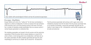 The AV junctional pacemaker will continue until it again starts to be
inhibited by impulses from the SA node. If the AV junction pacemaker fails
or its impulses are blocked, a ventricular pacemaker will take over. Its
rhythm is even slower, at 30 – 40 beats/min, and the QRS complexes will
be wide and abnormal.
Escape rhythms
Escape rhythms are a form of a “safety net” for the heart and develop in
response to a block or bradycardia. It serves to maintain the vital activation
of the ventricles and in turn the pumping activity of the heart.The heart
has a number of subsidiary ectopic pacemakers that can assume control if
normal impulse generation or conduction fails.
The subsidiary pacemakers are located in the AV junction and the ventricular
myocardium. If the AV junction fails to receive impulses as a result of SA
arrest or block, or even during severe sinus bradycardia, it will take over as
the cardiac pacemaker.The QRS complexes generated will have the same
morphology as normal but at a slower rate of around 40 – 60 beats/min.
Sinus rhythm with second-degree SA block and two AV junctional escape beats.
 