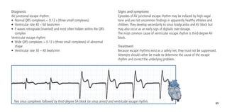 65
Diagnosis
AV junctional escape rhythm:
•	 Normal QRS complexes < 0.12 s (three small complexes)
•	 Ventricular rate 40 – 60 beats/min
•	 P waves retrograde (inverted) and most often hidden within the QRS
complex
Ventricular escape rhythm:
•	 Wide QRS complexes > 0.12 s (three small complexes) of abnormal
shape
•	 Ventricular rate 30 – 40 beats/min
Signs and symptoms
Episodes of AV junctional escape rhythm may be induced by high vagal
tone and are not uncommon findings in apparently healthy athletes and
children.They develop secondarily to sinus bradycardia and AV block but
may also occur as an early sign of digitalis over-dosage.
The most common cause of ventricular escape rhythm is third-degree AV
block.
Treatment
Because escape rhythms exist as a safety net, they must not be suppressed.
Attempts should rather be made to determine the cause of the escape
rhythm and correct the underlying problem.
Two sinus complexes followed by third-degree SA block (or sinus arrest) and ventricular escape rhythm.
 