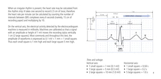 7
When an irregular rhythm is present, the heart rate may be calculated from
the rhythm strip. It takes one second to record 2.5 cm of trace; therefore
the heart rate per minute can be calculated by counting the number of
intervals between QRS complexes every 6 seconds (namely, 15 cm of
recording paper) and multiplying by 10.
On the vertical axis, the electrical activity detected by the electrocardiogram
machine is measured in millivolts. Machines are calibrated so that a signal
with an amplitude or height of 1 mV moves the recording stylus vertically
1 cm (2 large squares). Most commonly and throughout this text, the
amplitude of waveforms is expressed as 0.1 mV = 1 mm = 1 small square.
Thus each small square is 1 mm high and each large square 5 mm high.
Time and voltage.
Vertical axis:	
•	 1 small square = 1 mm (0.1 mV)
•	 1 large square = 5 mm (0.5 mV)
•	 2 large squares = 10 mm (1.0 mV)
Horizontal axis:
•	 1 small square = 0.04 s
•	 1 large square = 0.2 s
•	 5 large squares = 1.0 s
P-R
Interval
Q-T
Interval
QRS
Duration
1 sec
0.04 sec
0.2 sec
P
R
Q
S
T
U
1mm
5mm
1mV
PAPER SPEED - 25mm/sec
 