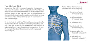 The 12-lead ECG
To make sense of an ECG, it is important to appreciate that the various
leads “view” the heart from different directions.The term “lead” does not
refer to the wires that connect the patient to the ECG machine, but rather
to different views of the heart’s electrical activity.An ECG machine uses the
information it collects via its four limb and 6 chest electrodes to compile a
comprehensive picture of the electrical activity in the heart as observed
from 12 different angles.
The six chest leads (V1
to V6
) “view” the heart from a horizontal plane.The
information from the limb electrodes is combined to produce the six limb
leads (I, II, III, aVR, aVL and aVF).The limb electrodes can be thought of as
looking at the heart in a vertical plane (that is, from the sides or the feet).
The information from these 12 leads is combined to form a standard
electrocardiogram.
Position of the six chest electrodes for
standard 12-lead electrocardiography.
V1
: right sternal border,
4th
intercostal space;
V2
: left sternal border,
4th
intercostal space;
V3
: between V2
and V4
;
V4
: mid-clavicular line,
5th
intercostals space;
V5
: anterior axillary line,
horizontally in line with V4
;
V6
: mid-axillary line,
horizontally in line with V4
 