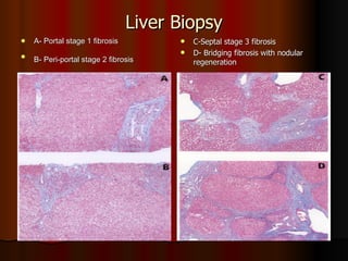 Liver Biopsy A- Portal stage 1 fibrosis B- Peri-portal stage 2 fibrosis C-Septal stage 3 fibrosis D- Bridging fibrosis with nodular  regeneration 