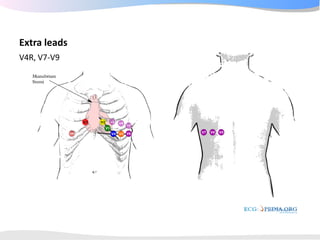ECGpedia ECG course part I: Basic electrocardiography