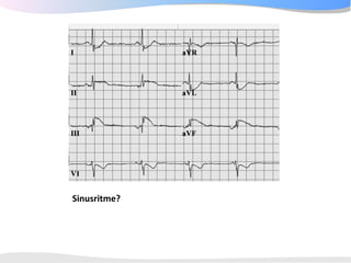 ECGpedia ECG course part I: Basic electrocardiography
