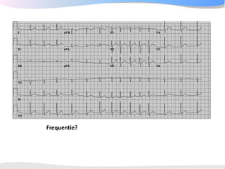 ECGpedia ECG course part I: Basic electrocardiography