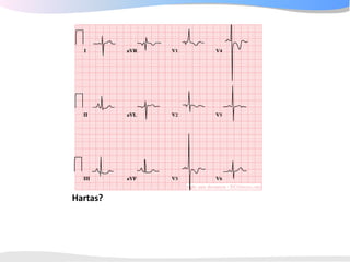 ECGpedia ECG course part I: Basic electrocardiography