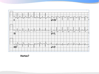 ECGpedia ECG course part I: Basic electrocardiography
