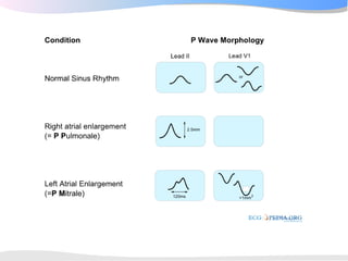 ECGpedia ECG course part I: Basic electrocardiography