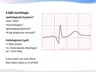 ECGpedia ECG course part I: Basic electrocardiography