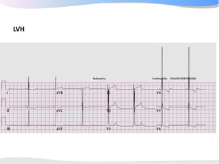 ECGpedia ECG course part I: Basic electrocardiography