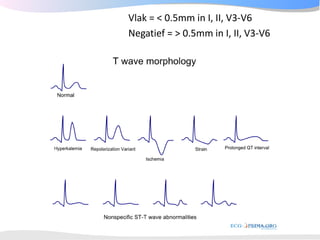 ECGpedia ECG course part I: Basic electrocardiography