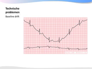 ECGpedia ECG course part I: Basic electrocardiography