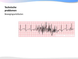 ECGpedia ECG course part I: Basic electrocardiography