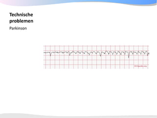ECGpedia ECG course part I: Basic electrocardiography