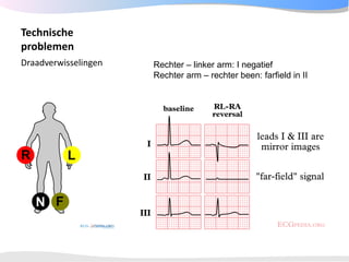 ECGpedia ECG course part I: Basic electrocardiography