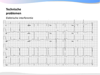 ECGpedia ECG course part I: Basic electrocardiography