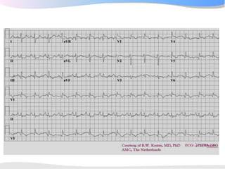 ECGpedia ECG course part I: Basic electrocardiography