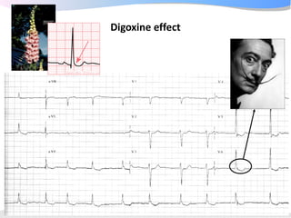 ECGpedia ECG course part I: Basic electrocardiography
