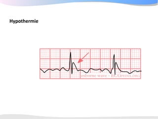 ECGpedia ECG course part I: Basic electrocardiography