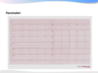ECGpedia ECG course part I: Basic electrocardiography