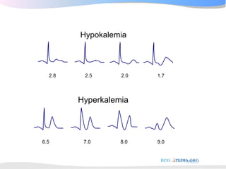 ECGpedia ECG course part I: Basic electrocardiography