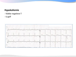 ECGpedia ECG course part I: Basic electrocardiography
