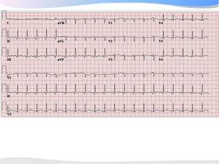 ECGpedia ECG course part I: Basic electrocardiography