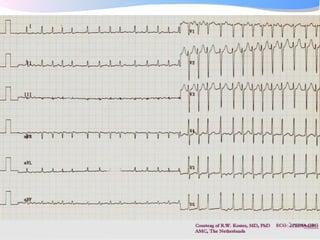 ECGpedia ECG course part I: Basic electrocardiography