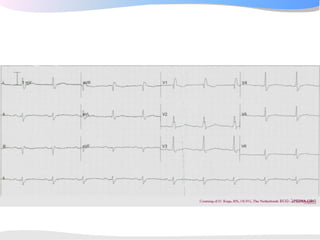 ECGpedia ECG course part I: Basic electrocardiography