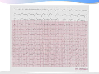 ECGpedia ECG course part I: Basic electrocardiography