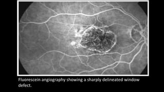 Fluorescein angiography showing a sharply delineated window
defect.
 