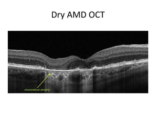 Age Related Macular Degeneration A Glimpse Into The Future PPTX age-related-macular-degeneration-a-glimpse-into-the-future-pptx
