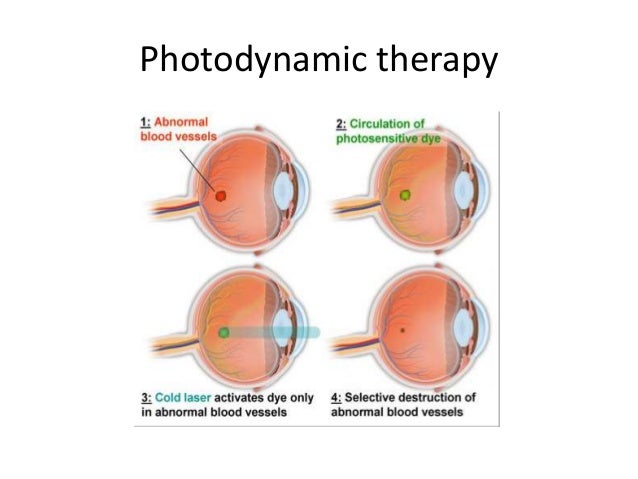 Age related macular degeneration  a glimpse into the future by Jahee…