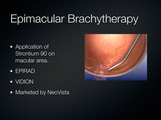 Epimacular Brachytherapy

Application of
Strontium 90 on
macular area.
EPIRAD
VIDION
Marketed by NeoVista
 