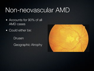 Non-neovascular AMD
 Accounts for 90% of all
 AMD cases
 Could either be:

    Drusen
    Geographic Atrophy
 