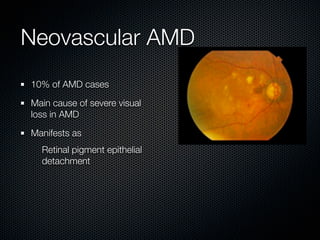 Neovascular AMD
10% of AMD cases

Main cause of severe visual
loss in AMD

Manifests as
  Retinal pigment epithelial
  detachment
 