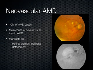 Neovascular AMD
10% of AMD cases

Main cause of severe visual
loss in AMD

Manifests as
  Retinal pigment epithelial
  detachment
 