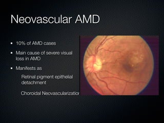 Neovascular AMD
10% of AMD cases

Main cause of severe visual
loss in AMD

Manifests as
  Retinal pigment epithelial
  detachment

  Choroidal Neovascularization
 