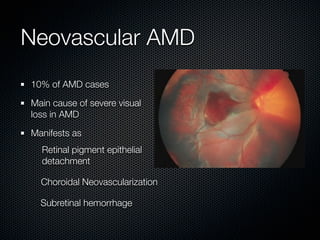 Neovascular AMD
10% of AMD cases

Main cause of severe visual
loss in AMD

Manifests as
  Retinal pigment epithelial
  detachment

  Choroidal Neovascularization

  Subretinal hemorrhage
 