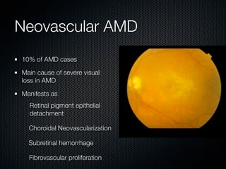 Neovascular AMD
10% of AMD cases

Main cause of severe visual
loss in AMD

Manifests as
  Retinal pigment epithelial
  detachment

  Choroidal Neovascularization

  Subretinal hemorrhage

  Fibrovascular proliferation
 