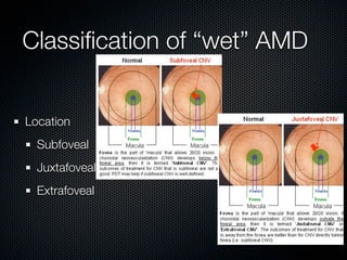 Classiﬁcation of “wet” AMD


Location
  Subfoveal
  Juxtafoveal
  Extrafoveal
 