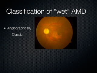 Classiﬁcation of “wet” AMD

Angiographically
   Classic
 