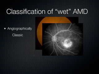 Classiﬁcation of “wet” AMD

Angiographically
   Classic
 