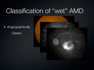 Classiﬁcation of “wet” AMD

Angiographically
   Classic
 