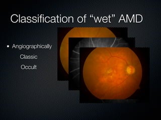 Classiﬁcation of “wet” AMD

Angiographically
   Classic
   Occult
 