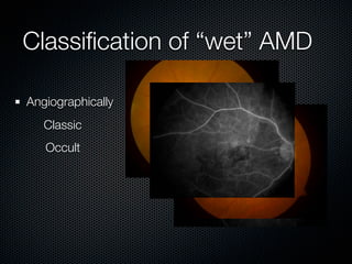 Classiﬁcation of “wet” AMD

Angiographically
   Classic
   Occult
 