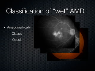 Classiﬁcation of “wet” AMD

Angiographically
   Classic
   Occult
 