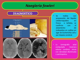 DIAGNOSTICO
• Se realiza con
preparación del liquido
cefalorraquídeo en
fresco o teñidas, se
confirma con el
aislamiento de
trofozoitos en cultivo en
agar de Escherichia coli y
por biopsia cerebral.
• La tomografía axial
computada mostrara
edema cerebral, zonas
con densidad disminuida
y parénquima.
 