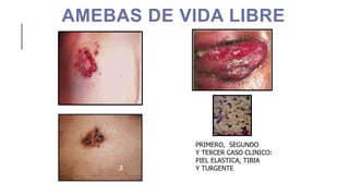 AMEBAS DE VIDA LIBRE
PRIMERO, SEGUNDO
Y TERCER CASO CLINICO:
PIEL ELASTICA, TIBIA
Y TURGENTE
1
3
2
4