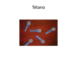 Tétano
 